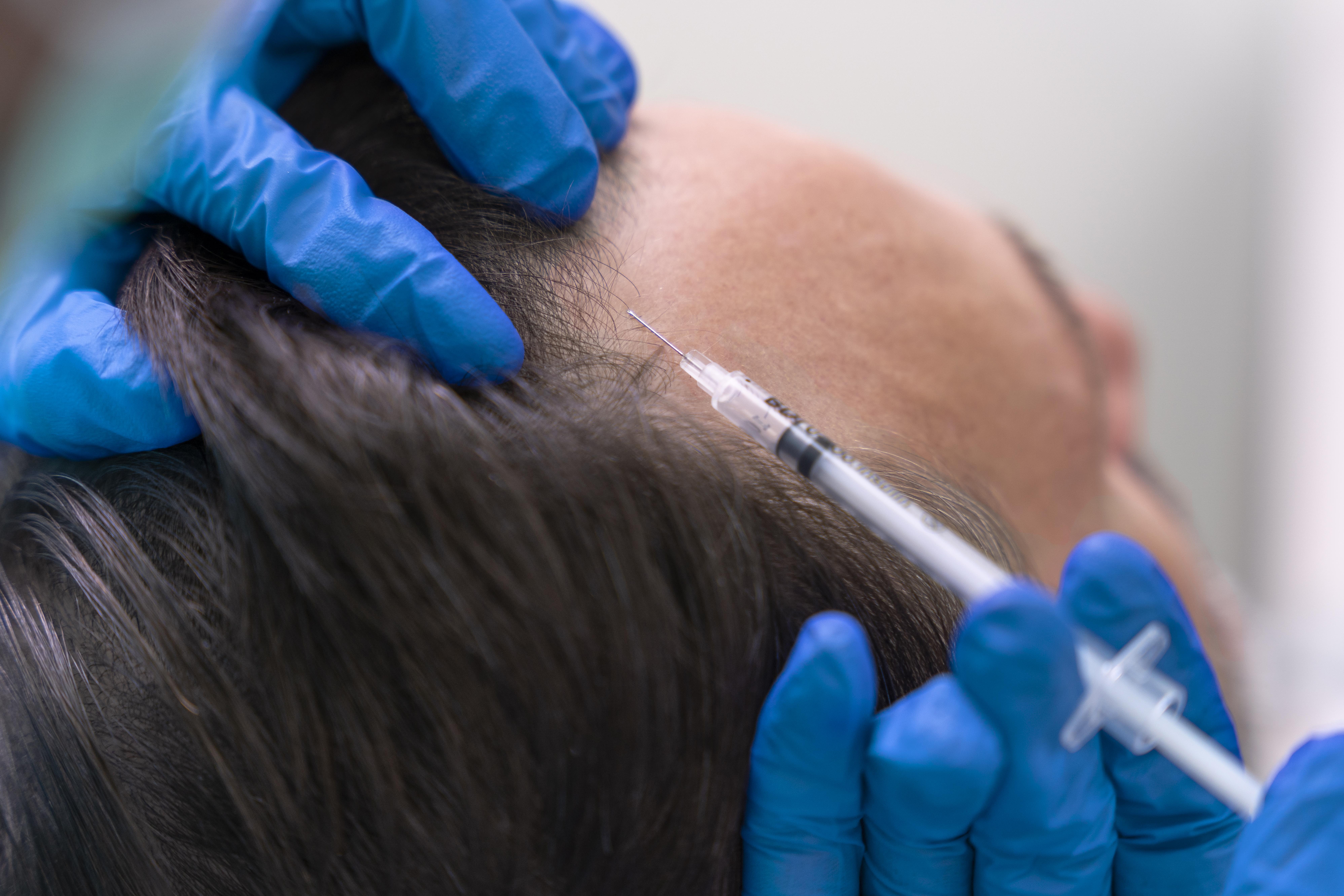 Hair PRP Therapy
